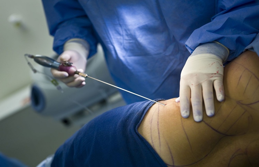 Liposuction Beyond Borders: Weighing the Pros and Cons of Surgery Abroad
